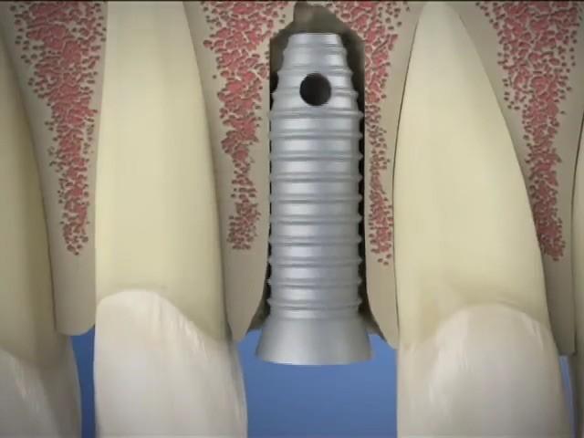 dental implant repair